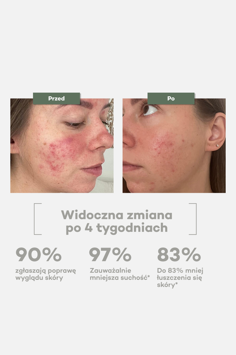 Uszkodzona skóra